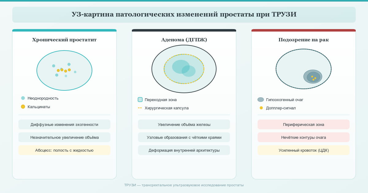 Патологические изменения простаты при ТРУЗИ: хронический простатит, аденома и подозрение на рак.